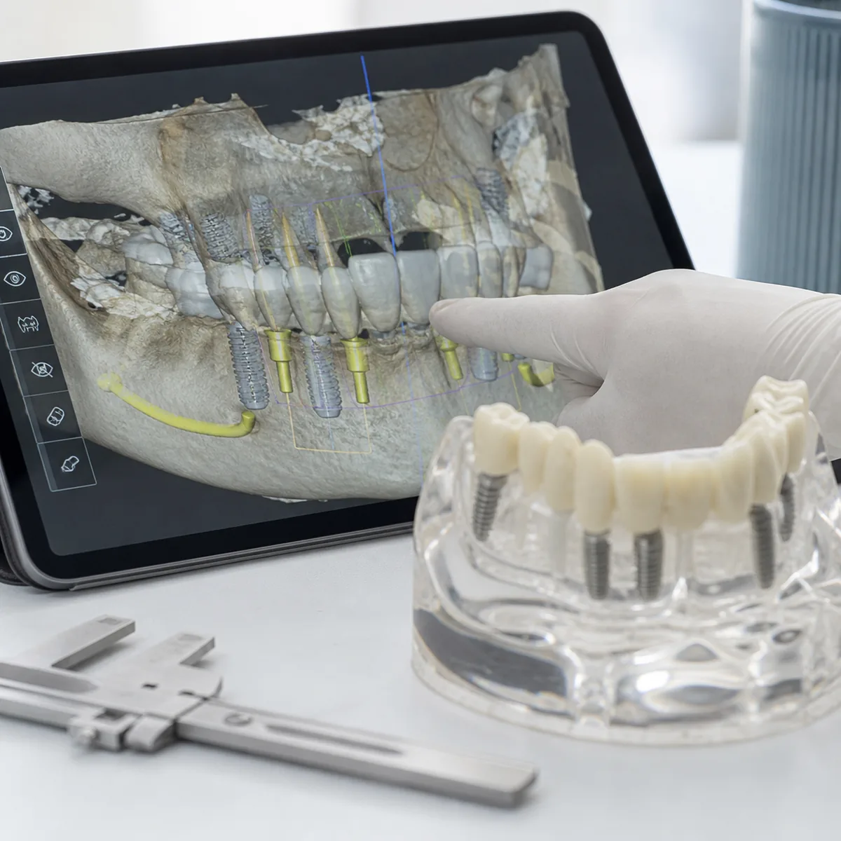 Avaliação para implantes dentários na Dra. Greice Trevisani em São Bento do Sul