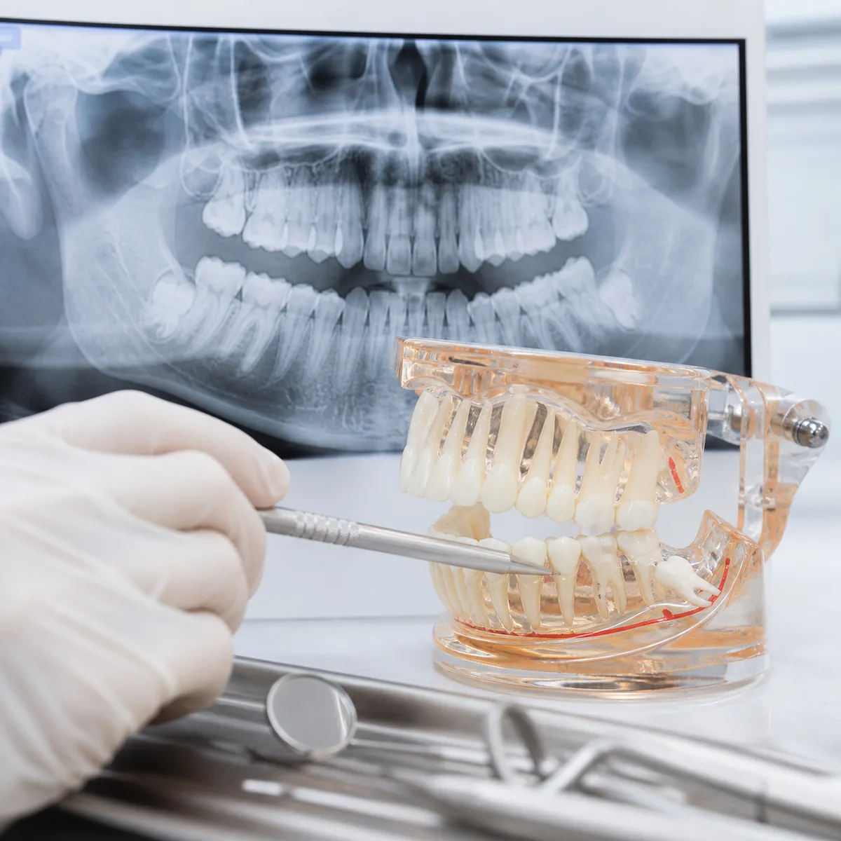 Extração dentária e de siso na Dra. Greice Trevisani em São Bento do Sul