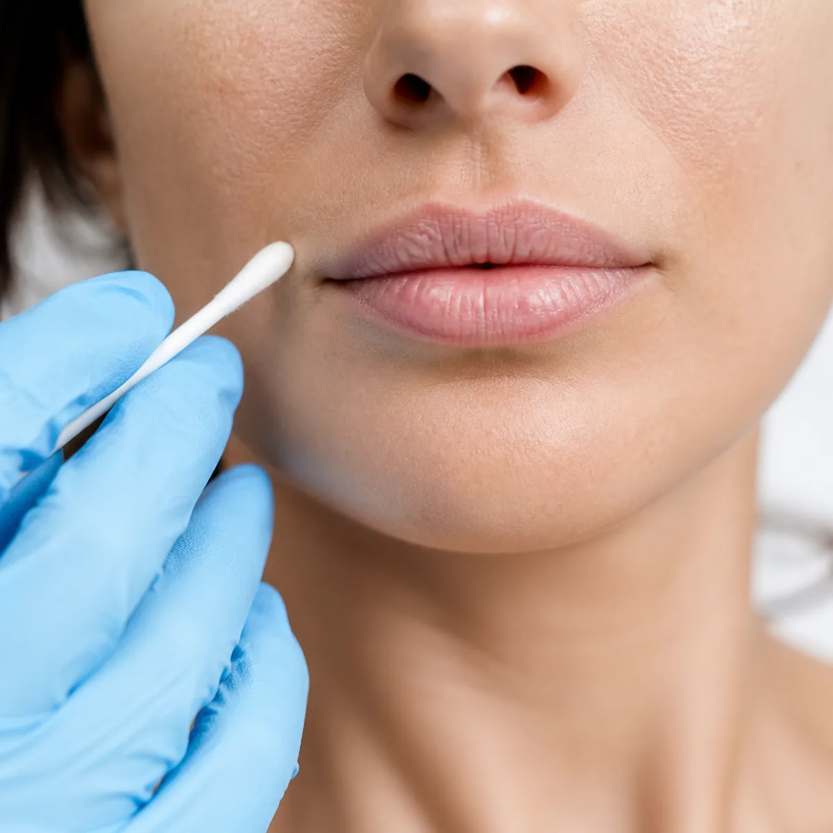 Preenchimento labial na Dra. Greice Trevisani em São Bento do Sul